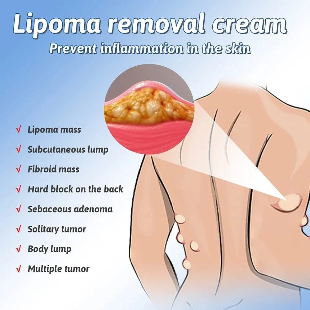 South Moon Lipoma Removal And Body Smoothing Cream 50g Herbal Natural Lump And Skin Knot Relief Ointment - Image 4