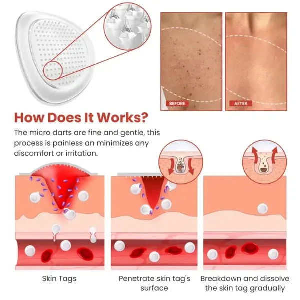 DermaSmooth Skin Tag Remover Patch – Fast, Safe, And Painless Skin Tag And Mole Removal Solution With No Scarring Or Pigmentation - Image 2